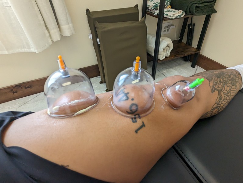 Cupping therapy at The Hive Chiropractic